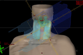 IMRT – Radioterapia de Intensidade Modulada e VMAT – Arcoterapia Volumétrica Modulada